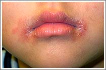 异位性皮肤炎也常并发反覆的口角炎